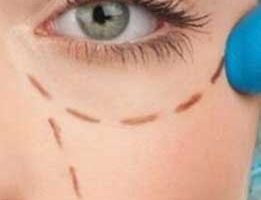 göz-kapagi-estetigi